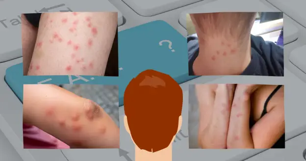 A keyboard with four images of different skin conditions, including bites, rashes, and possible bed bug bites. A person is looking at the keyboard.