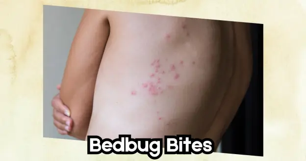 A close-up photo of a person's back with several small, red bumps scattered across the skin for bed bug bites 