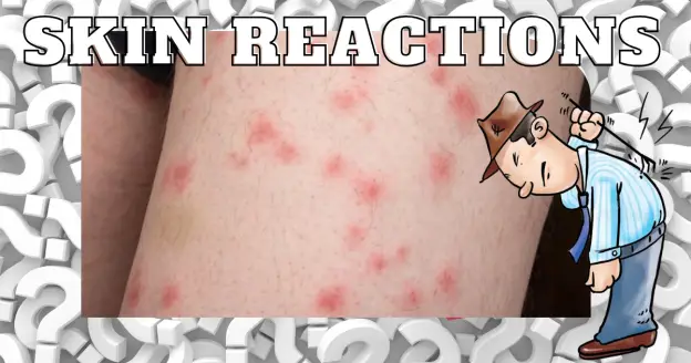 bedbugs bites skin reaction 