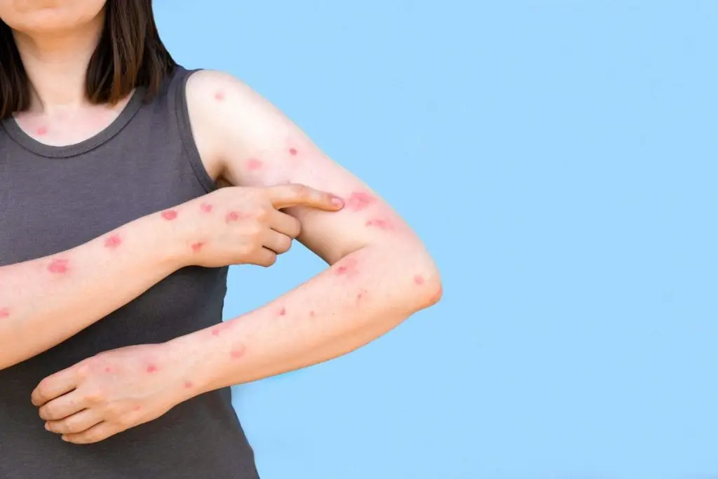 A women showing Body Early Signs of Bed Bugs